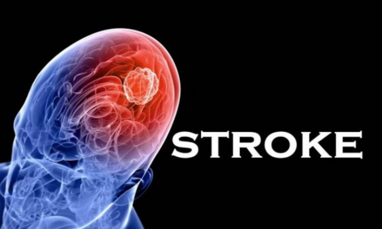 nuga.co Apakah Sakit Stroke Bisa Disembuhkan?